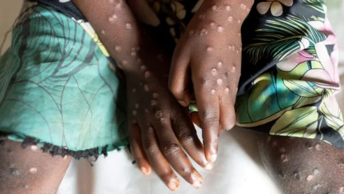 Mpox, a viral zoonotic disease that has re‑emerged globally in recent years, is now firmly on South Africa’s public health radar